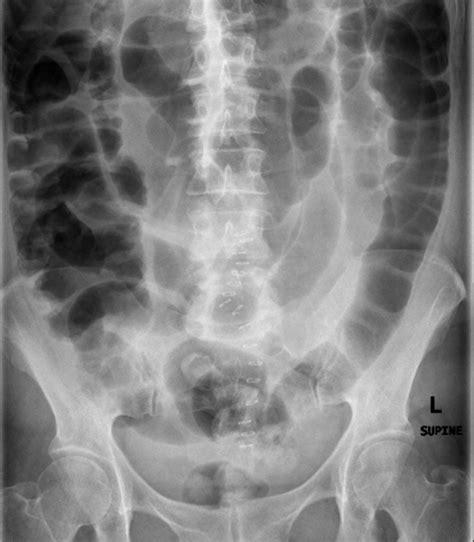 Ileus – Undergraduate Diagnostic Imaging Fundamentals