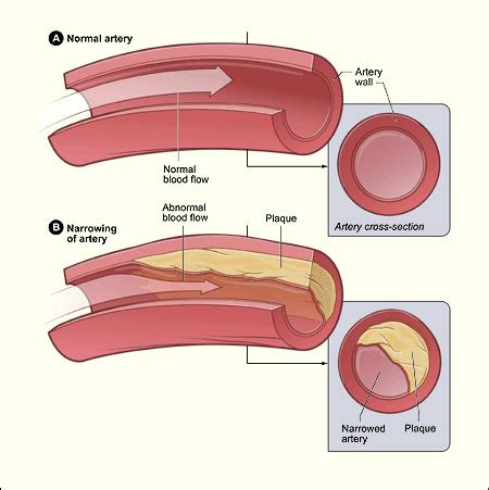 Atherosclerosis | UCSF Department of Surgery