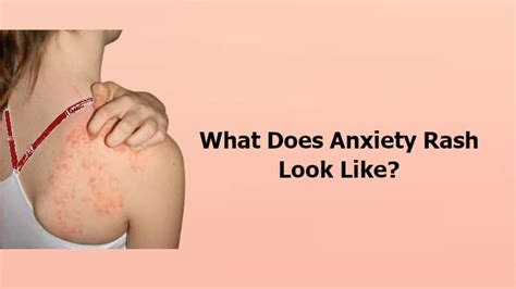 What Does Anxiety Rash Look Like? Causes and Symptoms