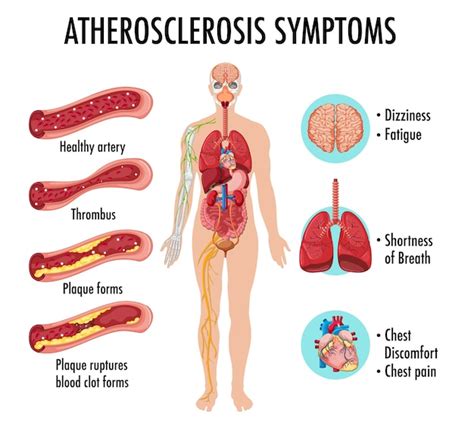 Free Vector | Stages of atherosclerosis information infographic