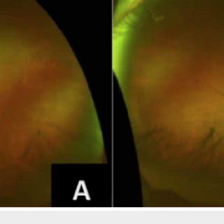 Bilateral disc edema (A) Left optic disc edema, blurred optic head ...