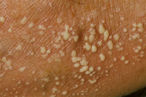 Pustular Eczema: Causes, Treatment, and Coping