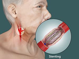 Carotid Stenting Sydney | Carotid Arteries Treatment Sydney