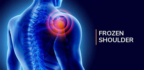 Frozen shoulder - Physioline