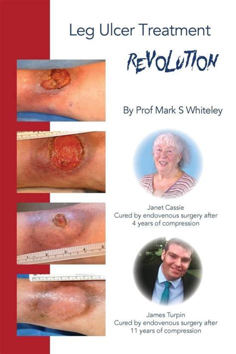 Leg Ulcer Treatment Revolution: Buy Leg Ulcer Treatment Revolution by ...