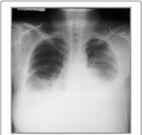 Pleural Effusion On X Ray