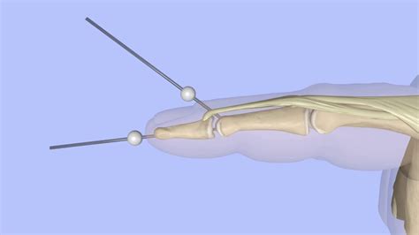 Extension Block Pinning of a Bony Mallet Finger - YouTube