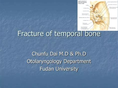 PPT - Fracture of temporal bone PowerPoint Presentation, free download ...