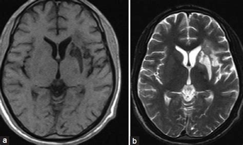 (a) T1W axial MRI image showing hypoiintense lesion in the left corpus ...