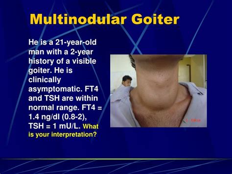 PPT - Simple (Nontoxic) Goiter: Diffuse and Multinodular PowerPoint ...