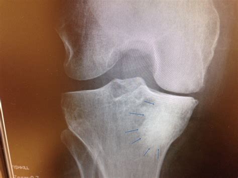 Bone Marrow Edema in the Knee – Howard J. Luks, MD