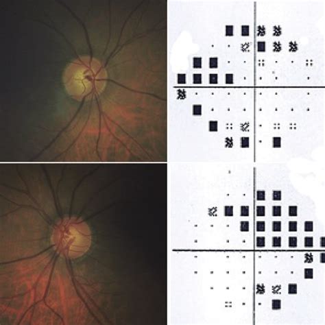 peripheral anterior synechiae in OD. Abbreviation: OD, right eye ...