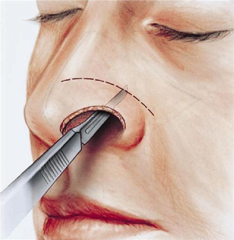 Techniques of columellar and alar nasal reconstruction - Operative ...