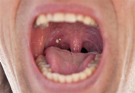 Tonsil Stones Might Be Causing Your Bad Breath – Cleveland Clinic