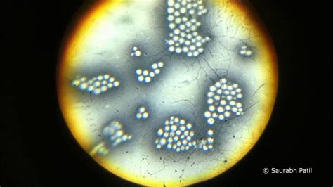 India Ink Cryptococcus : Cryptococcus neoformans in CSF - a photo on ...