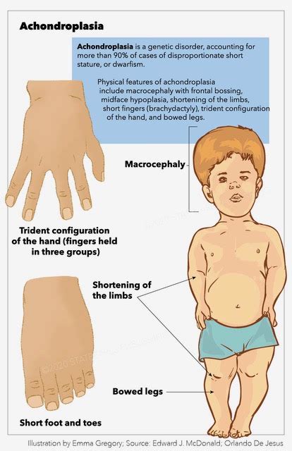 Achondroplasia – Monstrous.com