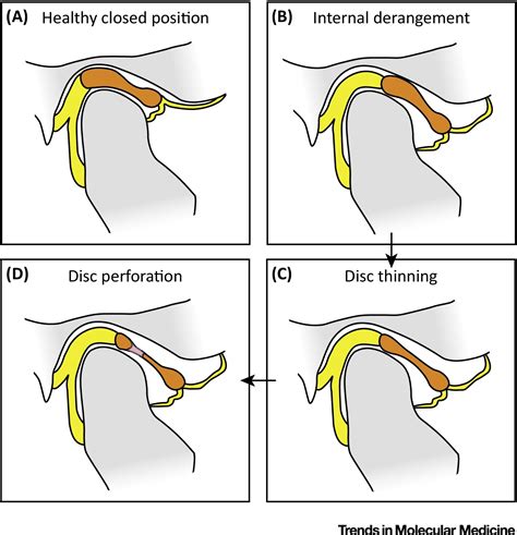 Remaining Hurdles for Tissue-Engineering the Temporomandibular Joint ...