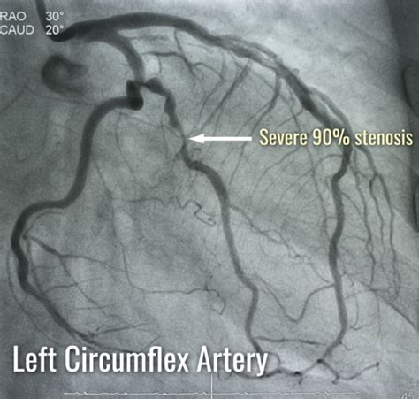 Left Coronary Artery Angiogram