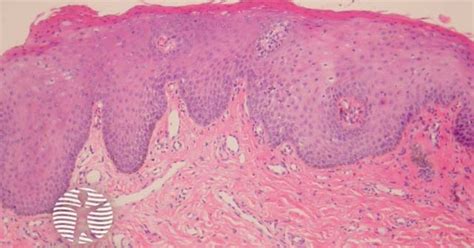 DermNet® - Labial melanotic macule pathology image