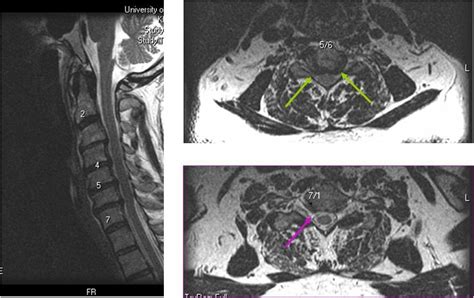 Foraminal Narrowing Mri