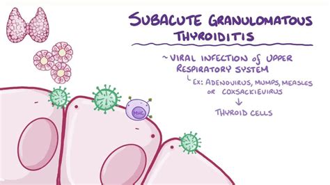 Subacute Thyroiditis