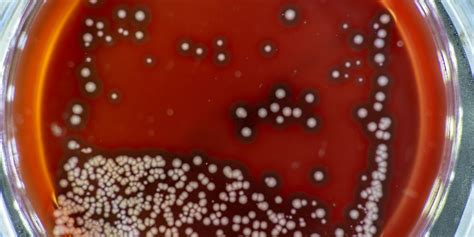 Golden staph infections increasing in WA | Community News Group