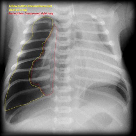 Pneumothorax chest x ray - wikidoc