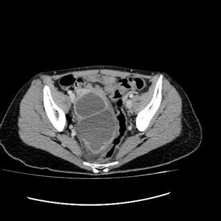 Right tubo-ovarian abscess. | Download Scientific Diagram