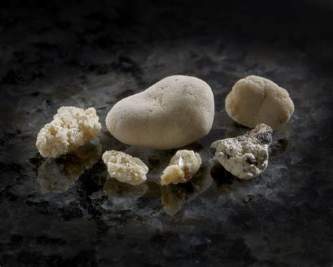 Kidney Stones | Manchester Urology Associates, PA