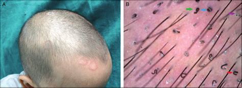 A. Clinical picture showing mixed variant: black dot and gray patch ...