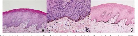 Figure 2 from Labial melanotic macule diagnosed by dermoscopy ...