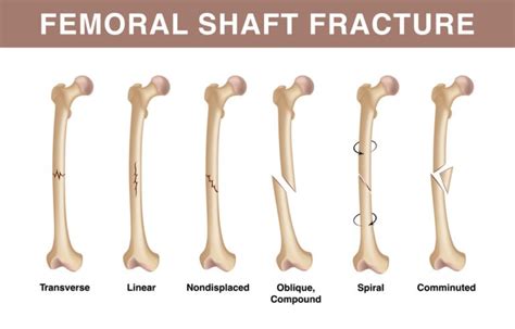 Femoral Shaft Fractures: Types, Causes and Treatment - Zealmax ...