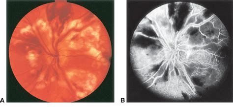 Purtscher retinopathy - American Academy of Ophthalmology