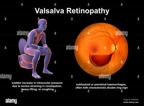 Illustration of Valsalva retinopathy, a pre-retinal haemorrhage caused ...