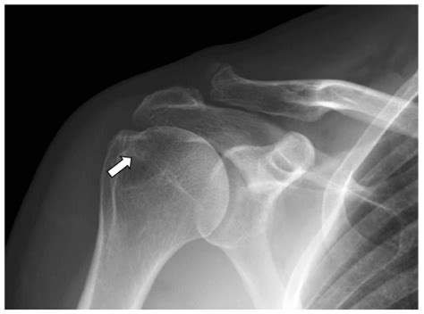 Anterior greater tuberosity subcortical cyst formation indicative of ...