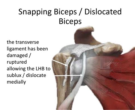 Long Head Biceps Tendon Subluxation