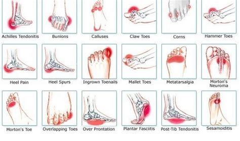 Types Of Foot Pain Diagnosis