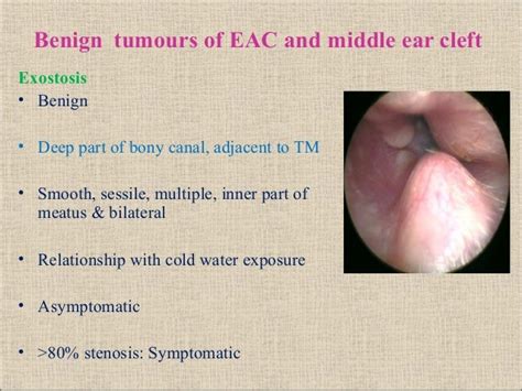 Glomus Tumor Ear