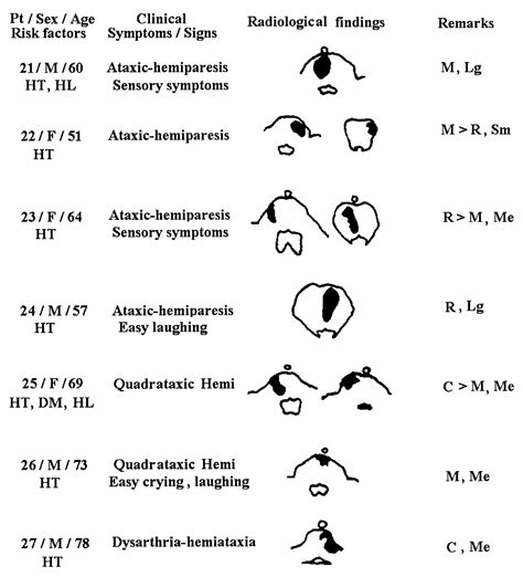 Paramedian Pontine Infarct