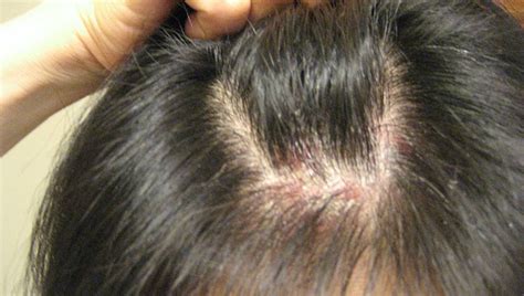 Suffering from Scalp Psoriasis? Coconut Oil Cure for Scalp Psoriasis ...