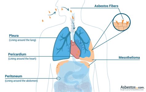 asbestos cancer: 25+ Asbestos Cancer Symptoms Images