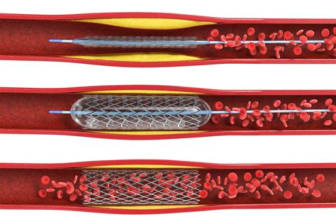 What is a Medical Device Stent? | ProPlate® ProPlate®