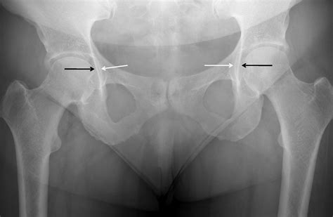 Acetabular Labrum Mri