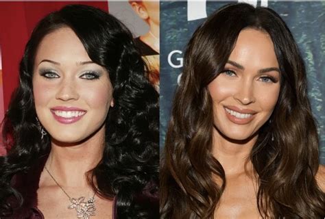 Celebrities With Veneers - Medic istanbul