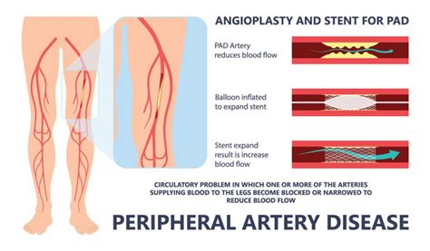 Angioplasty - Vascular Stent Treatment | Fairfax Vascular Center