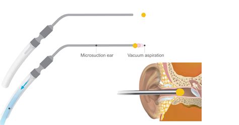 Ear Wax Removal: Why Microsuction is the Best Solution - Crystal Clear ...