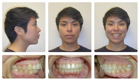 Orthodontic Before and After Photos | Brodsky Orthodontics