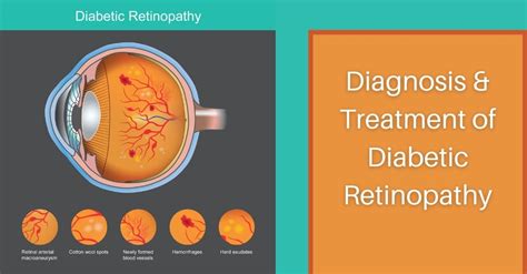 Diagnosis and Treatment of Diabetic Retinopathy