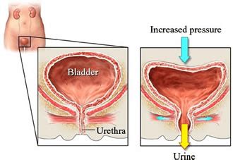 Bladder & Bowel Control - Physiotherapy Victoria BC