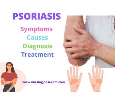 Psoriasis: Symptoms, Causes, Diagnosis, Treatment - Nursing Jobs Exam